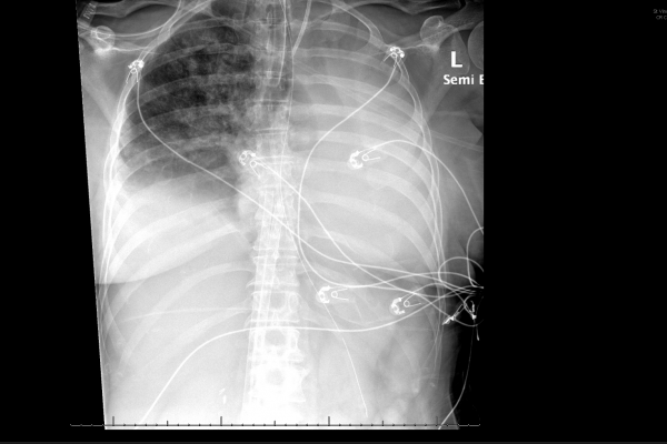 CXR 0706 CXR 0706