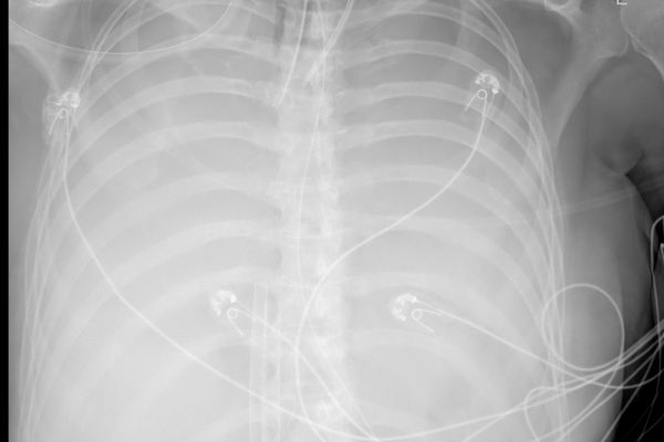 CXR 0906 CXR 0906