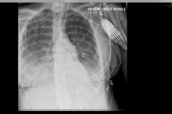 CXR 1006 post bronch CXR 1006 post bronch